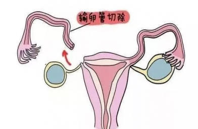 陕西慈铭博鳌国际医院三代试管婴儿，切除双侧输卵管还能做试管婴儿吗？